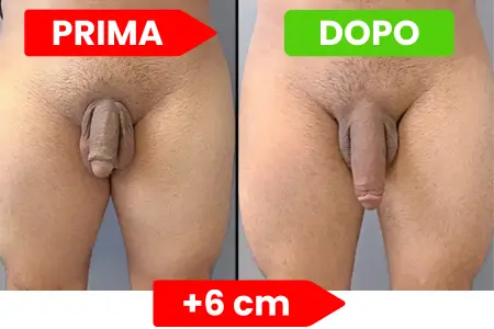 Marco - Prima e Dopo 6cm